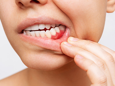 Village Dental of Leesburg | Oral Exams, Oral Cancer Screening and Arestin