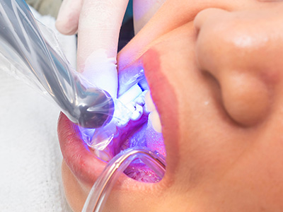 Village Dental of Leesburg | Teeth Whitening, Clear Braces and Deep Cleaning