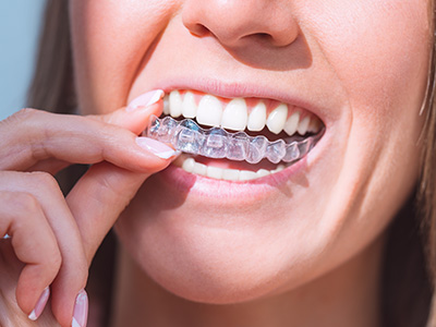 Village Dental of Leesburg | Dental Sealants, Veneers and Dental Cleanings