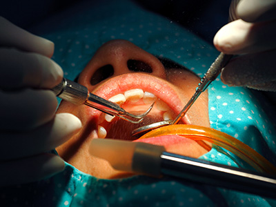 Village Dental of Leesburg | Arestin, Oral Hygiene and Oral Cancer Screening