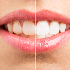 Village Dental of Leesburg | Full Mouth Reconstruction, Arestin and ZOOM  Whitening