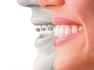 Village Dental of Leesburg | Arestin, Cosmetic Dentistry and Clear Braces