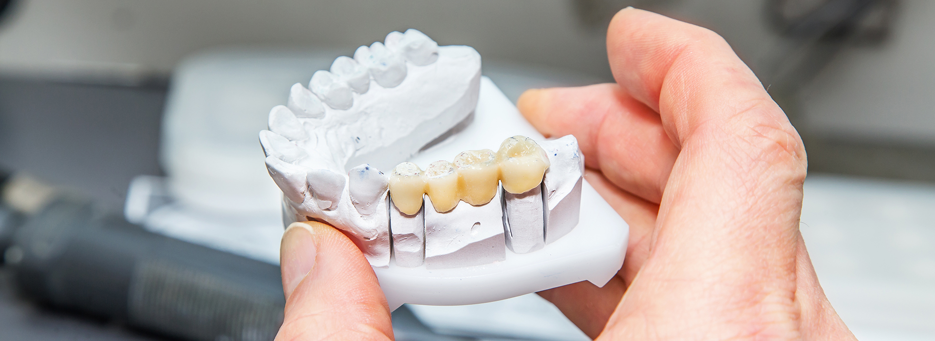 Village Dental of Leesburg | Cosmetic Dentistry, Inlays  amp  Onlays and Full Mouth Reconstruction