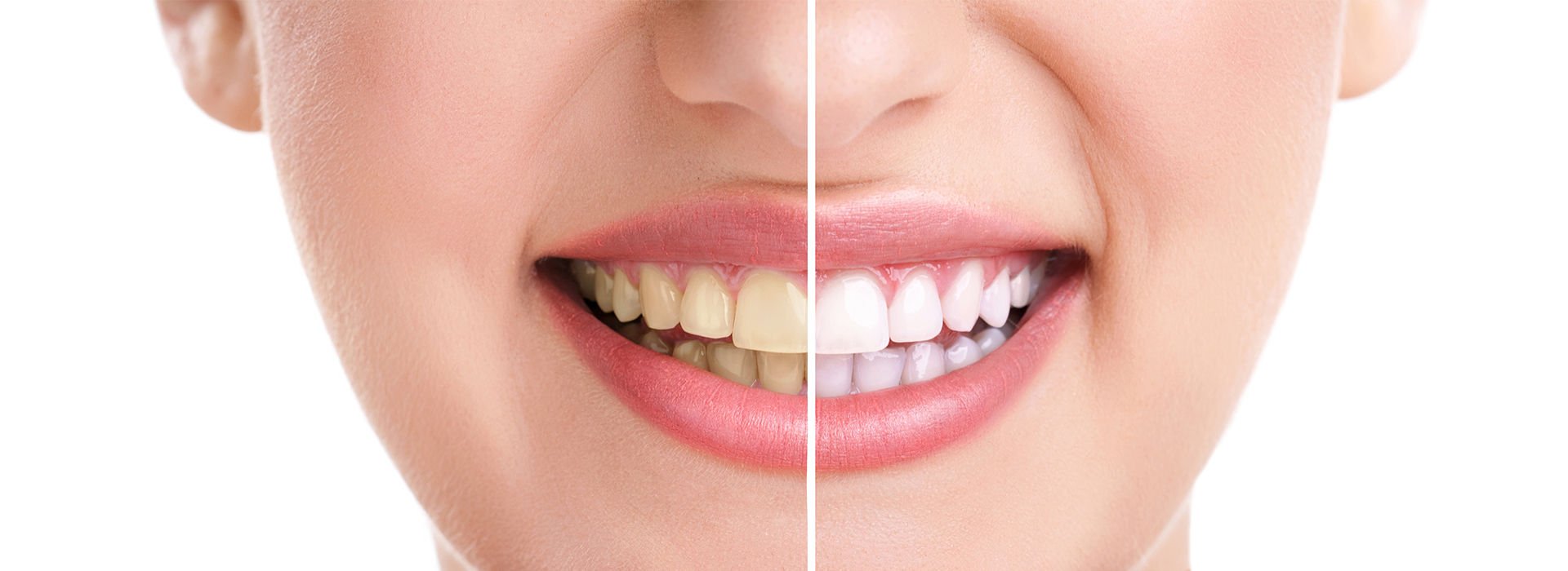 Village Dental of Leesburg | Implant Dentistry, Inlays  amp  Onlays and Dental Bridges