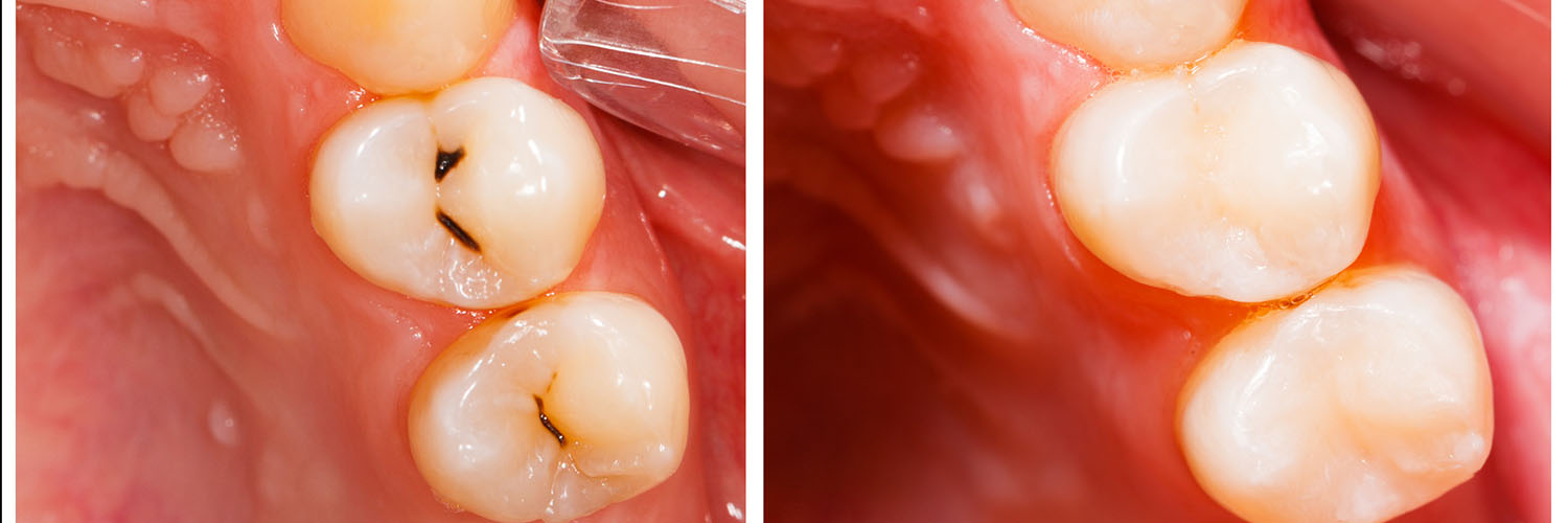 Village Dental of Leesburg | Periodontal Treatment, Dental Sealants and Clear Braces