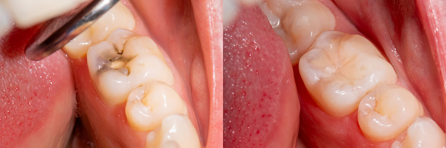 Village Dental of Leesburg | Oral Hygiene, Emergency Treatment and Full Mouth Reconstruction