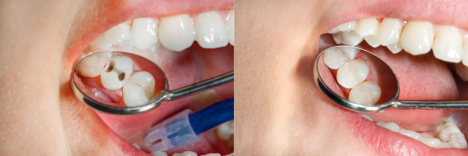 Village Dental of Leesburg | Extractions, Non Surgical Root Canal and Inlays  amp  Onlays