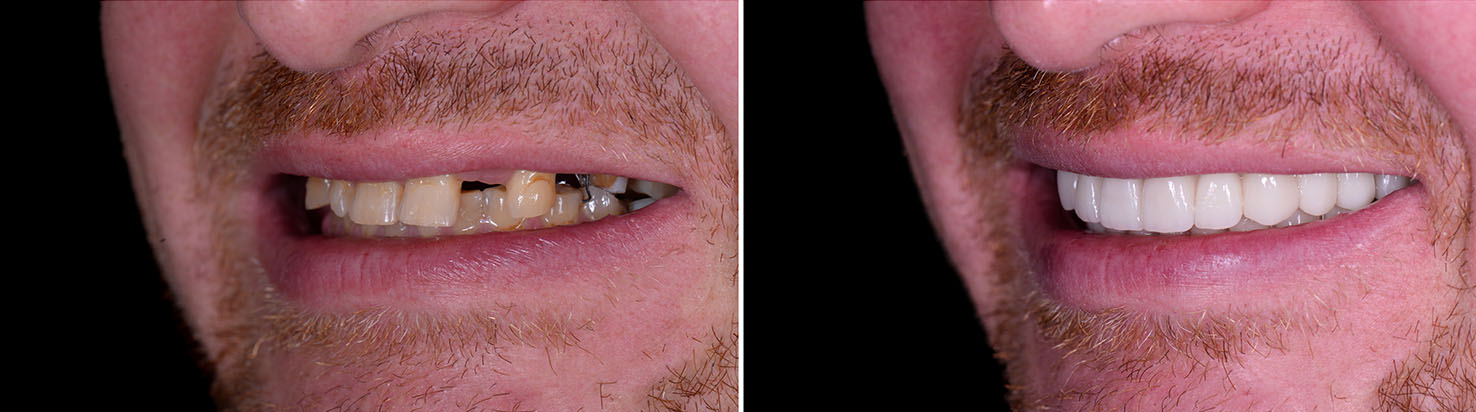Village Dental of Leesburg | Deep Cleaning, Dentures and Inlays  amp  Onlays