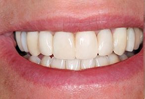 Village Dental of Leesburg | Inlays  amp  Onlays, Dental Fillings and Non Surgical Root Canal