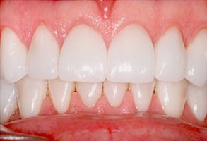 Village Dental of Leesburg | Implant Dentistry, Oral Exams and Non Surgical Root Canal