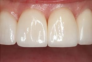 Village Dental of Leesburg | Inlays  amp  Onlays, Crowns and Veneers