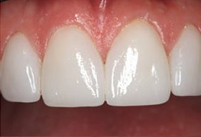 Village Dental of Leesburg | Full Mouth Reconstruction, Periodontal Treatment and Implant Dentistry
