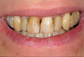 Village Dental of Leesburg | Oral Cancer Screening, Implant Dentistry and Veneers