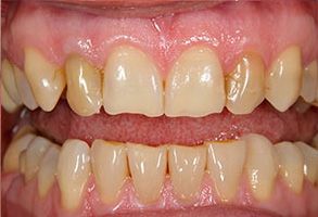Village Dental of Leesburg | Dental Sealants, Invisalign reg  and Preventative Program
