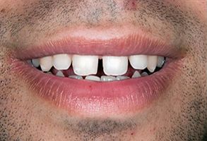 Village Dental of Leesburg | Periodontal Treatment, Deep Cleaning and Dentures